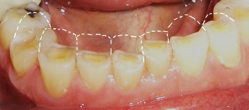 Nhận biết và điều trị nghiến răng - Ảnh 3.