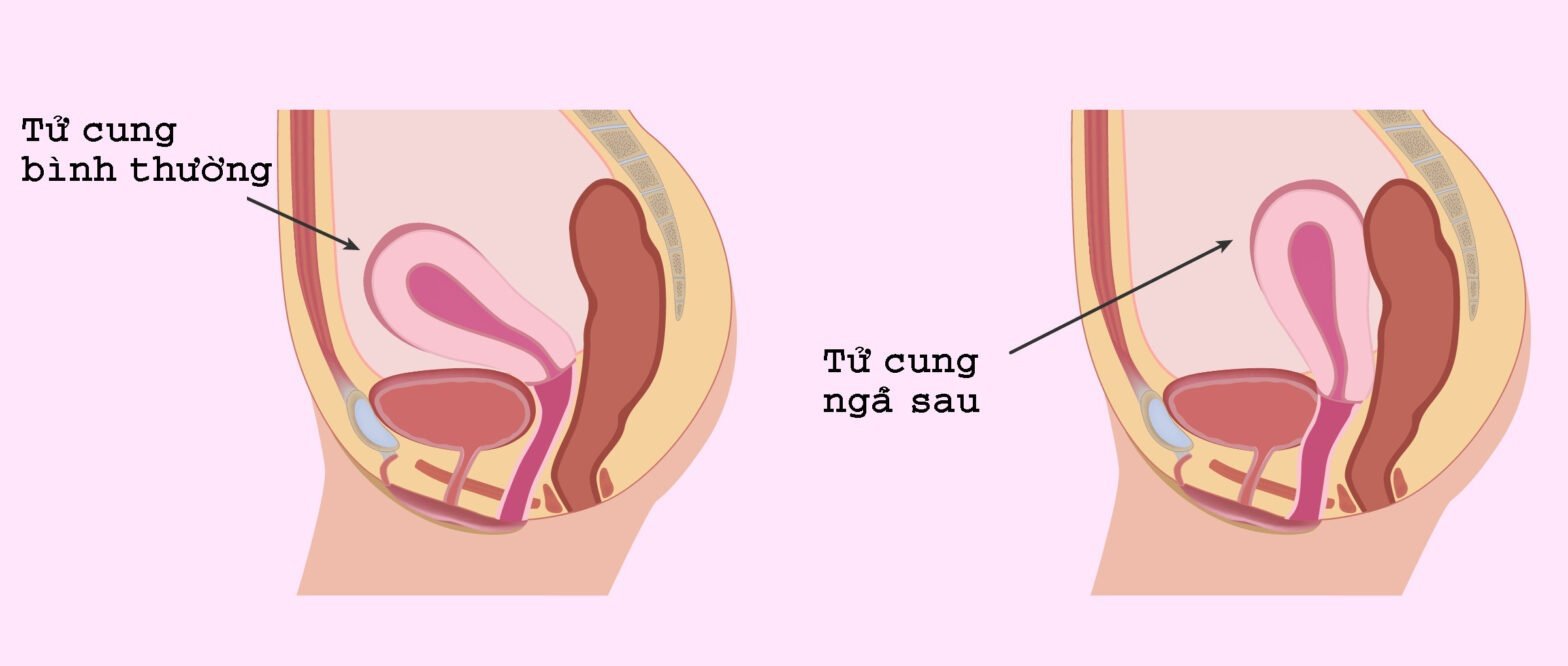 Tử cung ngả sau ảnh hưởng đến thai kỳ?