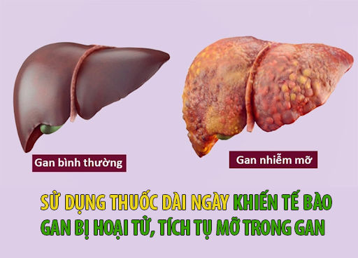 Điều trị viêm khớp dạng thấp thường xuyên bị nóng gan, làm sao để cải thiện? - Ảnh 3.