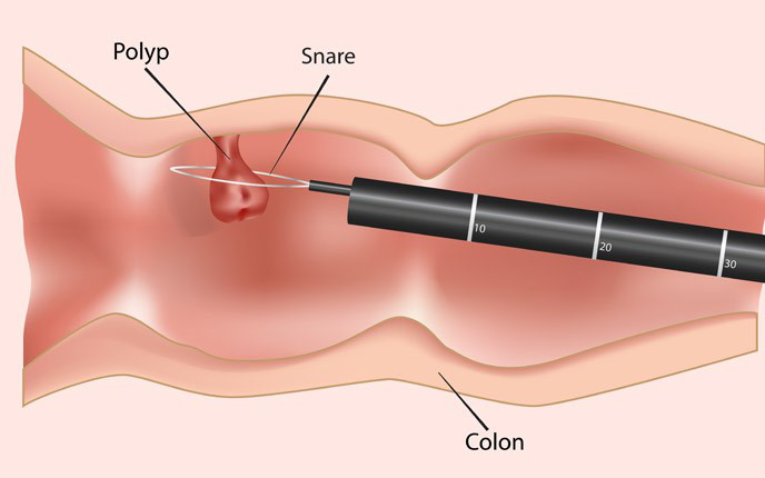 Phát hiện sớm ung thư đại tràng tăng cơ hội điều trị thành công