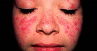 Người bệnh Lupus ban đỏ đã có thêm một lựa chọn điều trị mới - Ảnh 1.