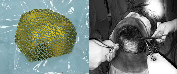 Phẫu thuật tạo hình khuyết hổng xương sọ bằng công nghệ 3D - Ảnh 2.