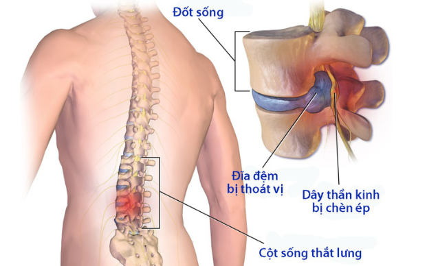 Đau dây thần kinh liên sườn, căn bệnh hay tái phát