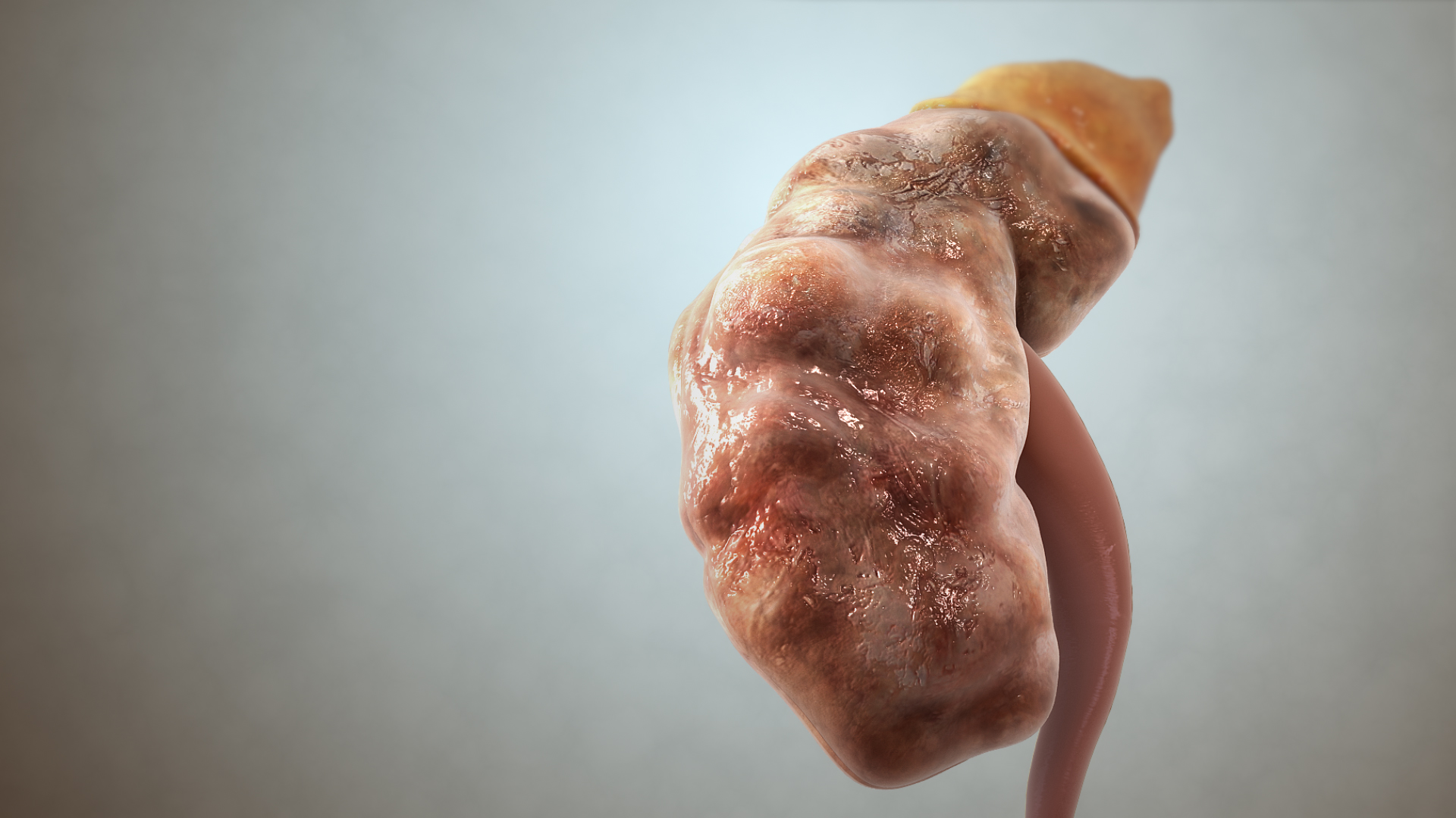 Suy thận độ 3 và cách hỗ trợ cải thiện từ cây dành dành - Ảnh 1.