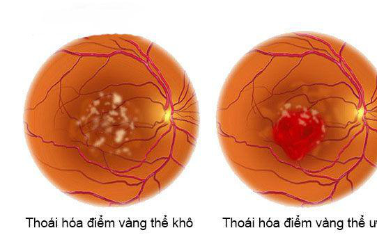 FDA cấp phép thuốc sinh học tương tự lucentis trị bệnh thoái hóa điểm vàng