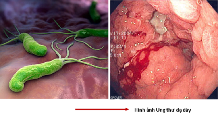 Ung thư dạ dày: Nguyên nhân, biểu hiện, cách điều trị và phòng bệnh- Ảnh 2.