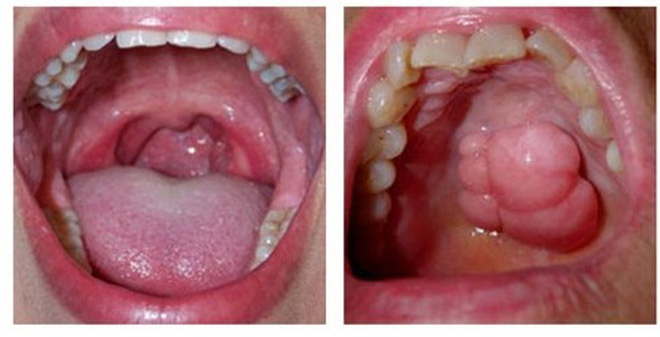 Ngoài thuốc lá, yếu tố nào làm tăng nguy cơ ung thư khoang miệng?- Ảnh 1.