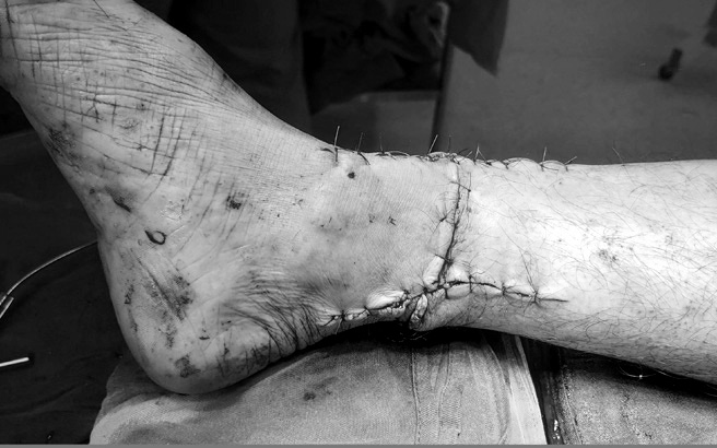 Hồi sinh cánh tay đứt lìa dập nát trong 'giờ vàng'- Ảnh 2.