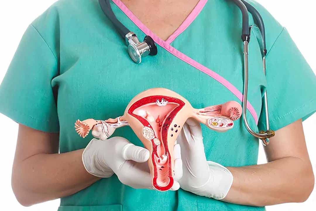 Polyp nội mạc tử cung: Nguyên nhân, nhận biết và các phương pháp điều trị