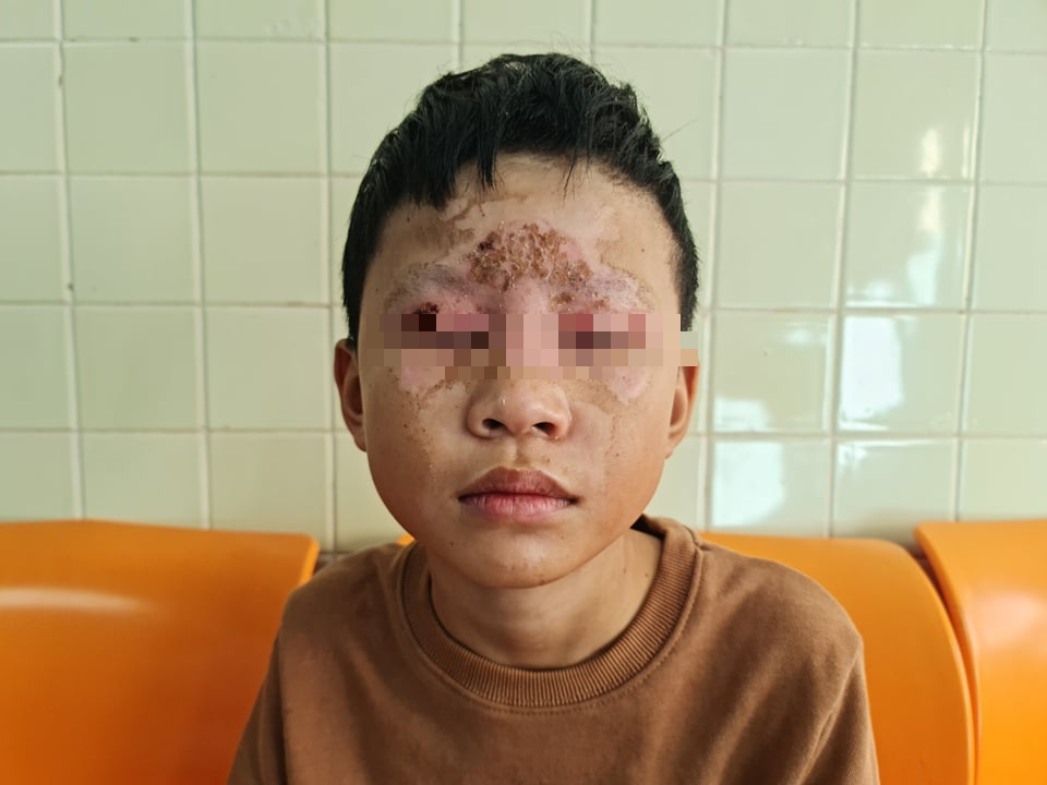 Tự chế pháo nổ theo mạng xã hội, bé 10 tuổi bị bỏng vùng mặt thương tâm - Ảnh 1.