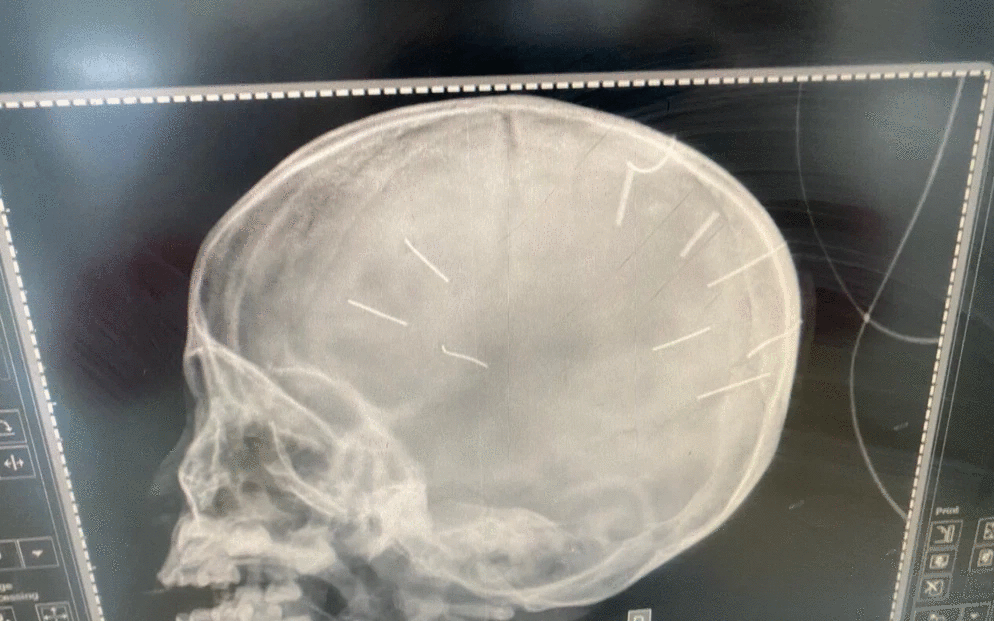Hà Nội: Bé gái 3 tuổi cấp cứu khi đã hôn mê, co giật, phát hiện 9 vật thể lạ trong sọ não