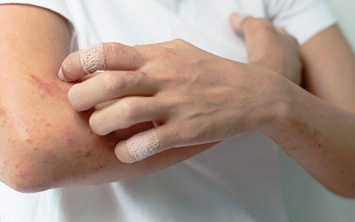 Viêm đa cơ là gì, có thuốc nào chữa trị?