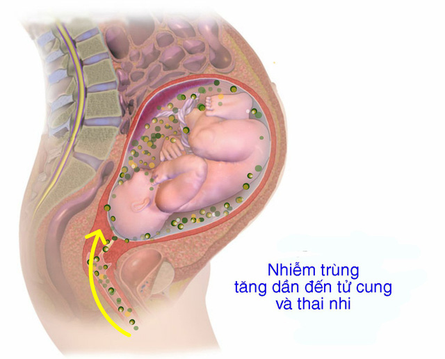 Viêm màng ối: Nhiễm trùng trong thai kỳ - biến chứng nghiêm trọng cho mẹ và thai nhi - Ảnh 1.