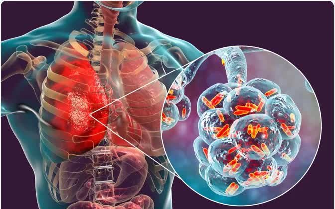 Biện pháp hỗ trợ giảm triệu chứng viêm phổi khi trời trở lạnh tại nhà