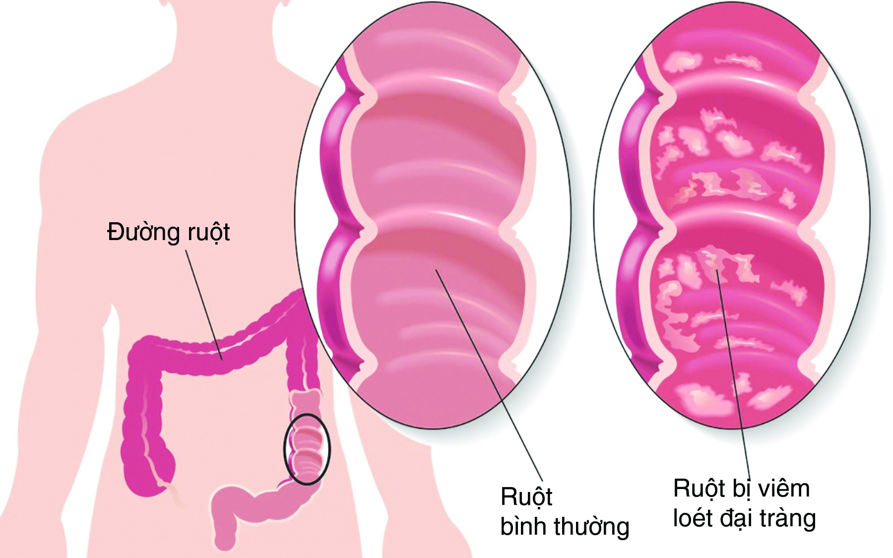 Liệu pháp kết hợp thuốc có thể giúp chữa viêm loét đại tràng hiệu quả