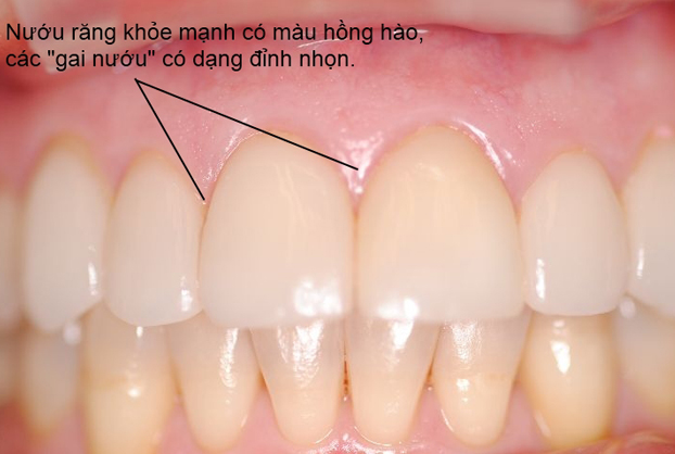 Ngăn ngừa viêm nướu răng bằng chế độ dinh dưỡng hiệu quả  - Ảnh 3.