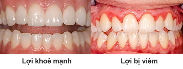 Ngăn ngừa viêm nướu răng bằng chế độ dinh dưỡng hiệu quả  - Ảnh 2.