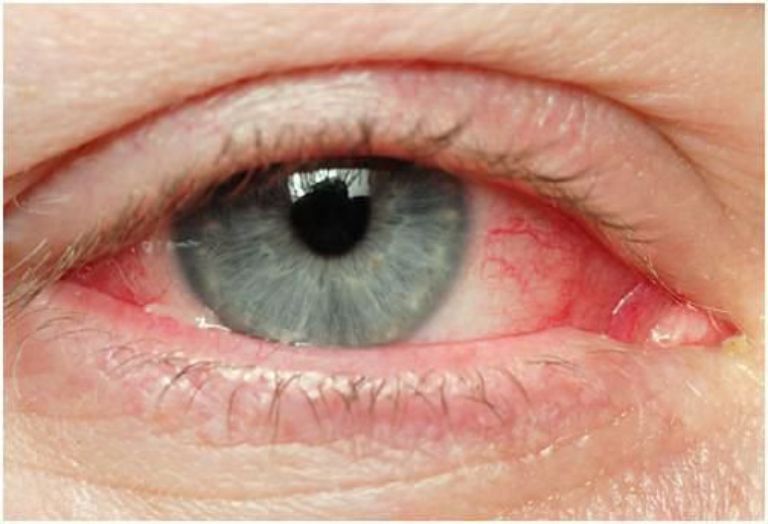 Sử dụng thuốc nhỏ mắt steroid: Chỉ định và biến chứng - Ảnh 3.