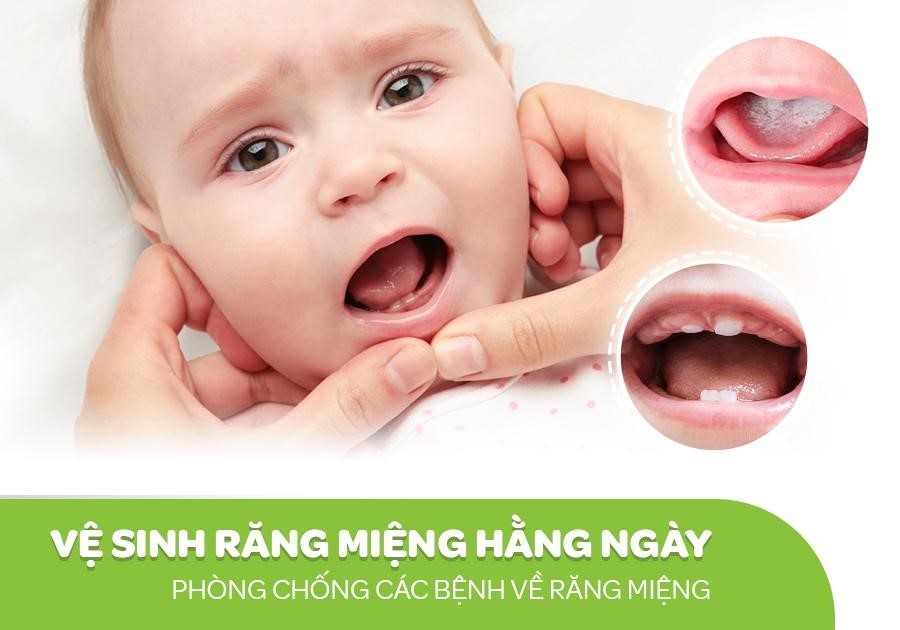 Gạc răng miệng tẩm ẩm đúng tiêu chuẩn cho trẻ nhỏ