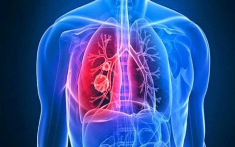 5 triệu chứng thường gặp của bệnh xơ phổi- Ảnh 2.