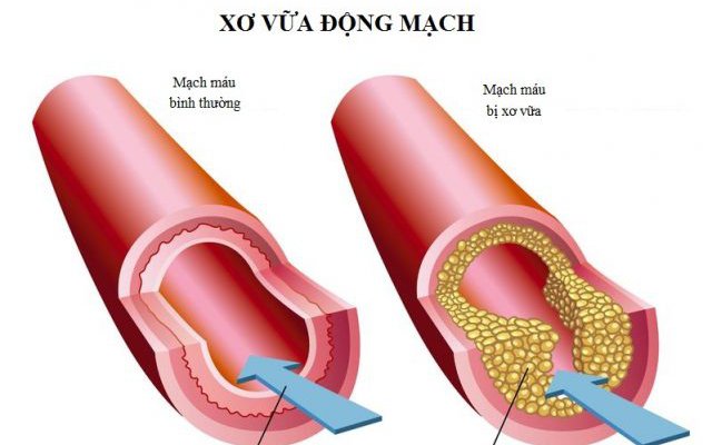 Xơ vữa động mạch ai dễ mắc?