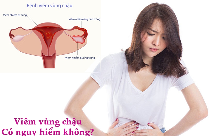 Viêm vùng chậu: Nguyên nhân, biểu hiện và hệ lụy