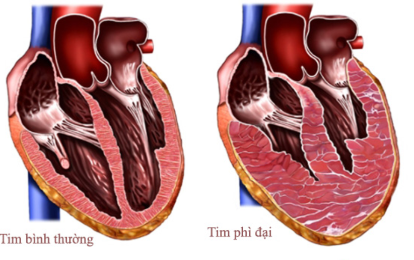 FDA chấp nhận ứng dụng thuốc mới trong bệnh cơ tim phì đại tắc nghẽn - Ảnh 1.