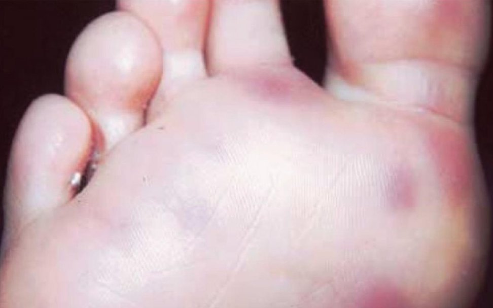 Viêm tuyến mồ hôi bàn chân tự phát có điều trị được không?