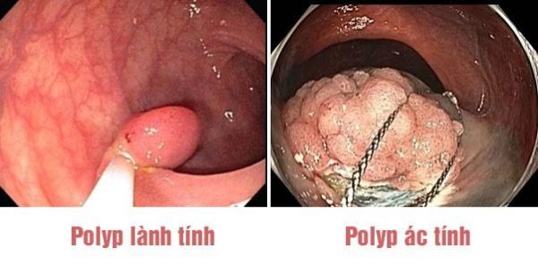 Các yếu tố nguy cơ gây polyp đại tràng và người bệnh cần làm gì? - Ảnh 2.