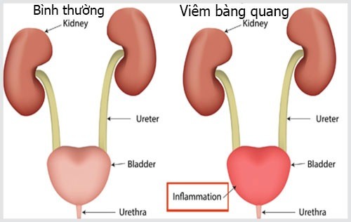 Các biến chứng gây ra bởi viêm bàng quang - Ảnh 1.