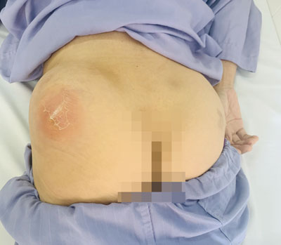 Vùng mông trái của người bệnh khi nhập viện đang áp xe, căng mủ