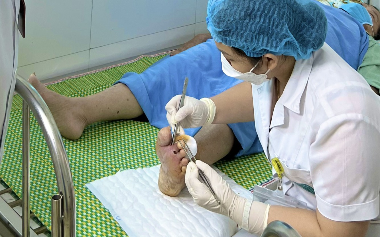 Tự đắp thuốc kháng sinh chữa đái tháo đường, một người phải tháo bỏ ngón chân