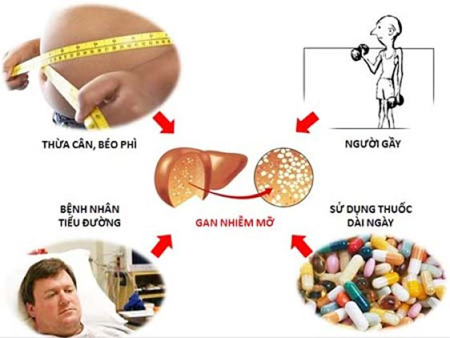 Một số thuốc khiến gan nhiễm mỡ và biện pháp xử lý - Ảnh 1.
