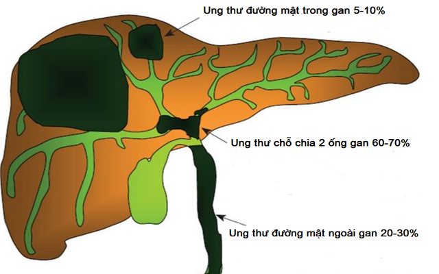 Phác đồ mới điều trị ung thư đường mật trong gan