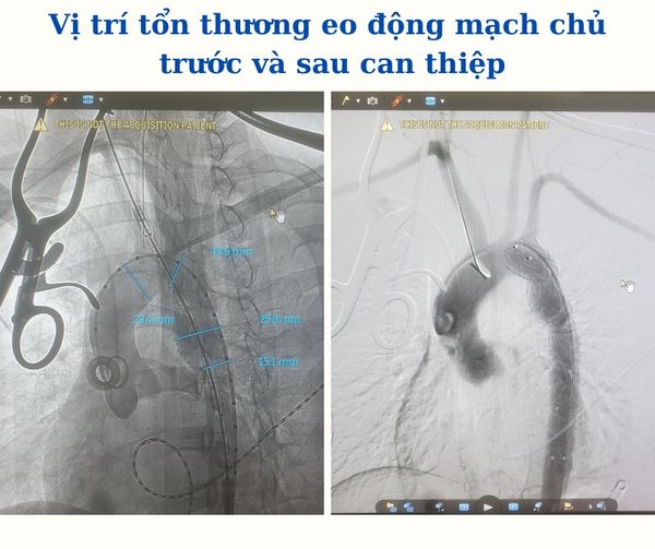Cô gái trẻ thoát 'cửa tử' ngoạn mục khi rơi từ tầng 5 xuống đất - Ảnh 1. Cô gái trẻ thoát 'cửa tử' ngoạn mục khi rơi từ tầng 5 xuống đất - Ảnh 1.