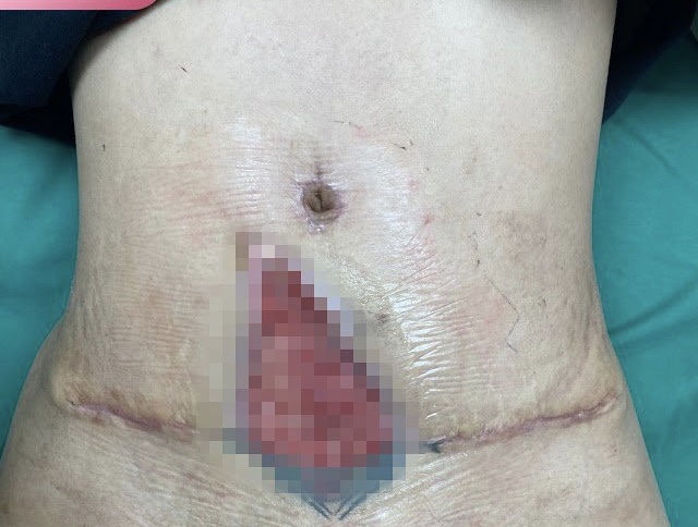 Người phụ nữ ở Hà Nội bị biến chứng, loét da vùng bụng sau hút mỡ ...