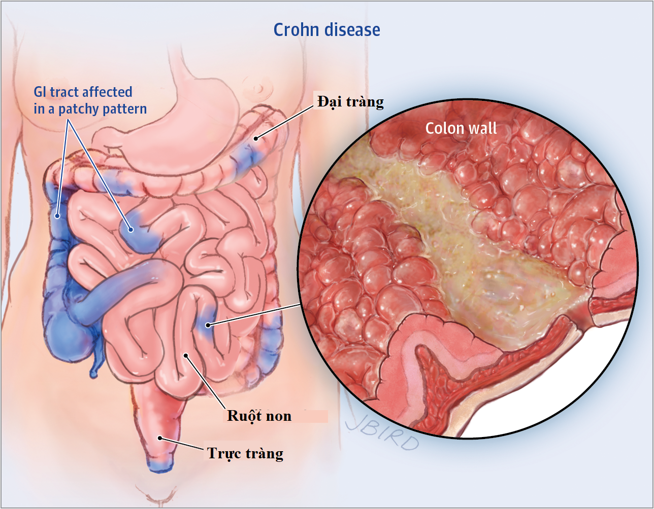 Làm thế nào để phòng ngừa bệnh Crohn?