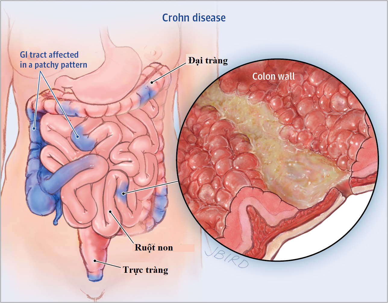 Bệnh Crohn có biểu hiện và những hệ lụy gì? - Ảnh 2.