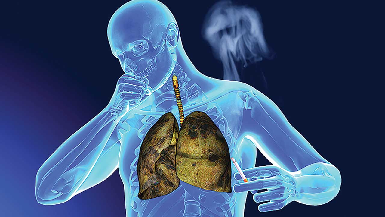 Ung thư phổi - những điều cần biết   - Ảnh 4.