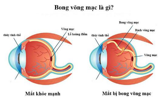 Bong võng mạc – Căn bệnh nên lưu ý ở mắt cận thị cao