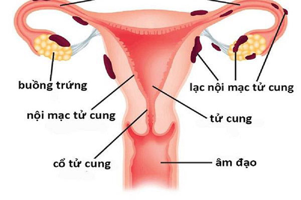 Lạc nội mạc tử cung có thể gây vô sinh, dấu hiệu cần đi khám - Ảnh 3.