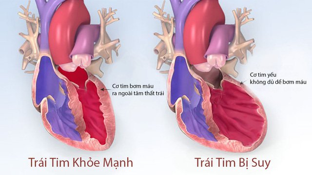 Thuốc giúp cải thiện gánh nặng triệu chứng ở bệnh nhân suy tim - Ảnh 1.