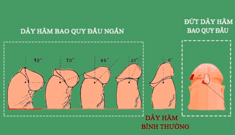 Đứt dây hãm bao quy đầu có tự lành?