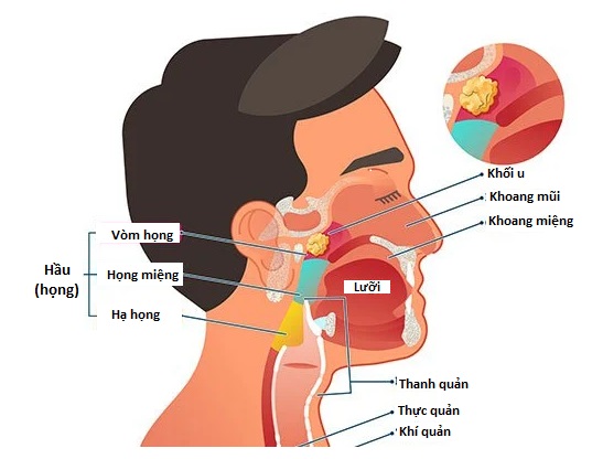 Ai nên thực hiện tầm soát ung thư vòm họng và 4 dấu hiệu cảnh báo căn bệnh này - Ảnh 2.