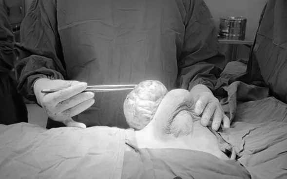 Ngực không cân đối, cô bé 15 tuổi phát hiện mắc khối u vú khổng lồ hiếm gặp