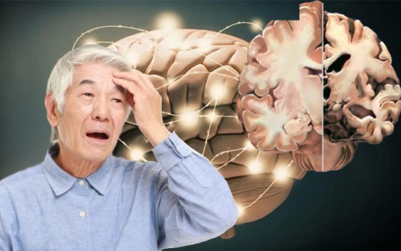 Cách ngăn ngừa bệnh Alzheimer tiến triển