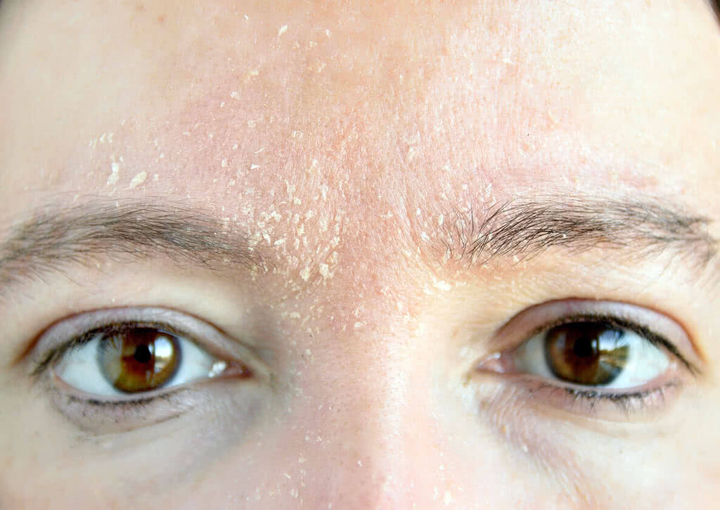 Nhận biết và khắc phục tình trạng khô da mùa lạnh