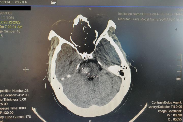 Nữ bệnh nhân đột quỵ khi đang điều trị loét dạ dày - Ảnh 1.