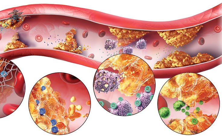 Rối loạn lipid máu - Nguyên nhân của nhiều bệnh lý nguy hiểm