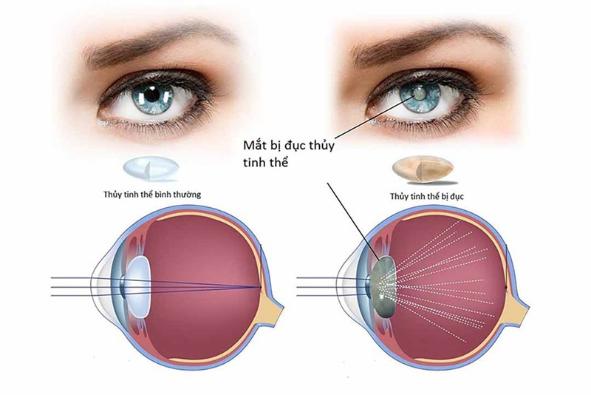 3 bệnh mắt mùa hè: Nguy cơ đục thuỷ tinh thể từ tia cực tím